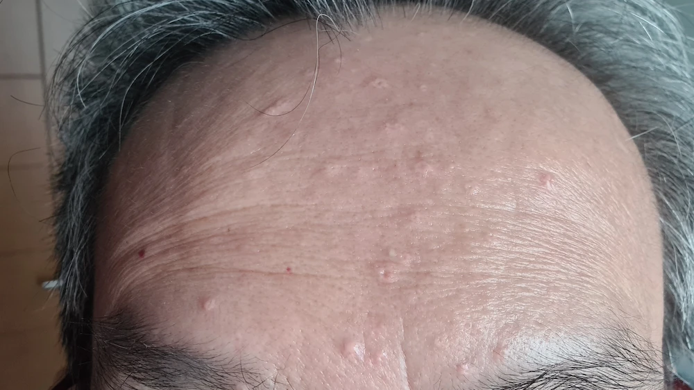 a man with bumps on forehead