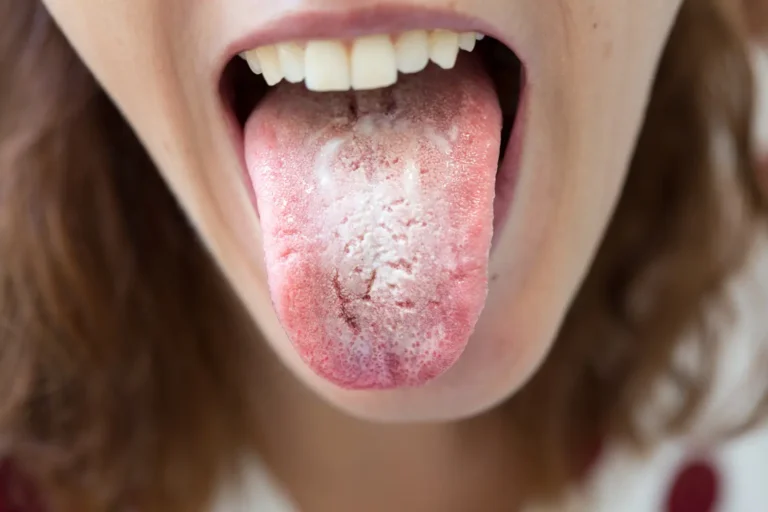 Chlamydia Bumps on Tongue: Understanding Oral Chlamydia